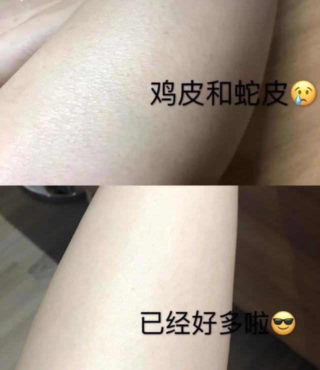 冬天局部皮肤瘙痒鸡皮