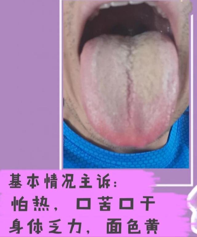舌头有裂纹是怎么回事（常见的裂纹舌辩证）