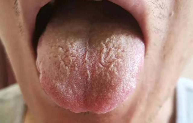 一补就上火？舌头有齿痕，舌苔比较厚？这7种舌象不要着急进补