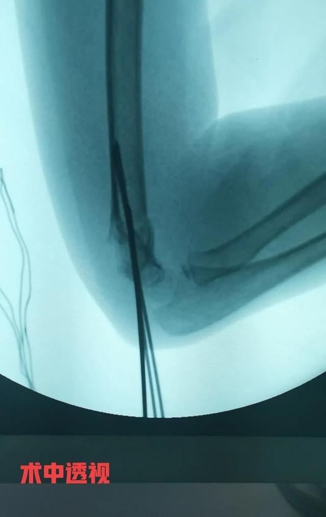 小儿肱骨髁上骨折小知识