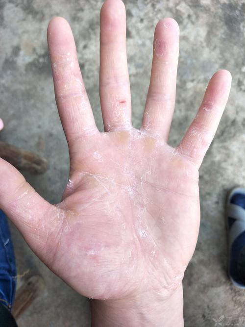手蜕皮怎么办