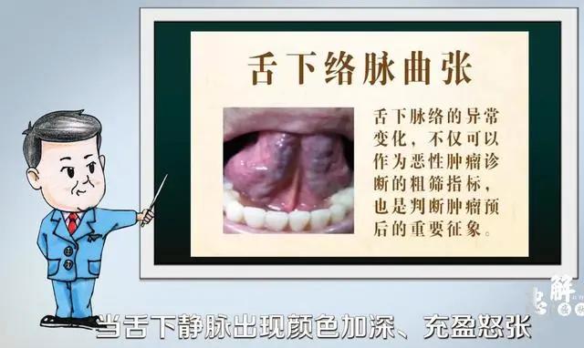 醫生提醒：癌變前，耳朵舌頭會“求救”！厚白苔肺癌，肝癭線肝癌