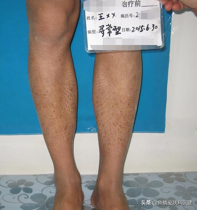 治疗鱼鳞哪里去