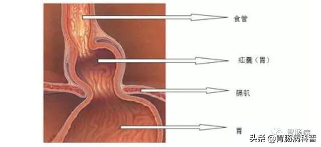 食道癌部分角化