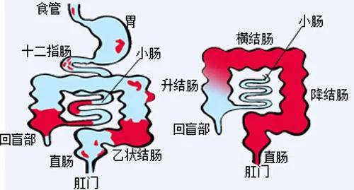 肠易激综合征的诊断标准和中医辨证论治及用方用药