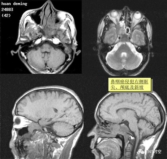 鼻咽鳞状上皮增生伴不全角化