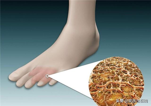 角化型脚气可以撕皮吗