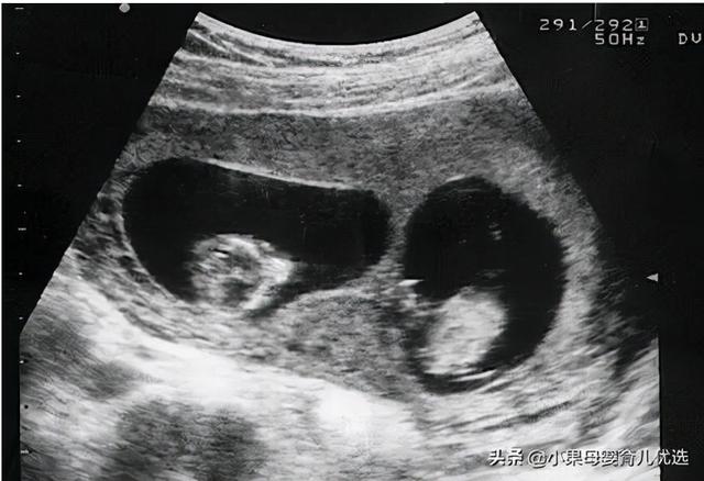 90后妈妈生下龙凤胎，刚要缝合大喊“等一下”，医生哭笑不得