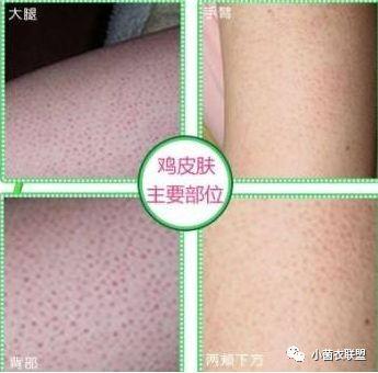 鸡皮肤会不会遗传下一代