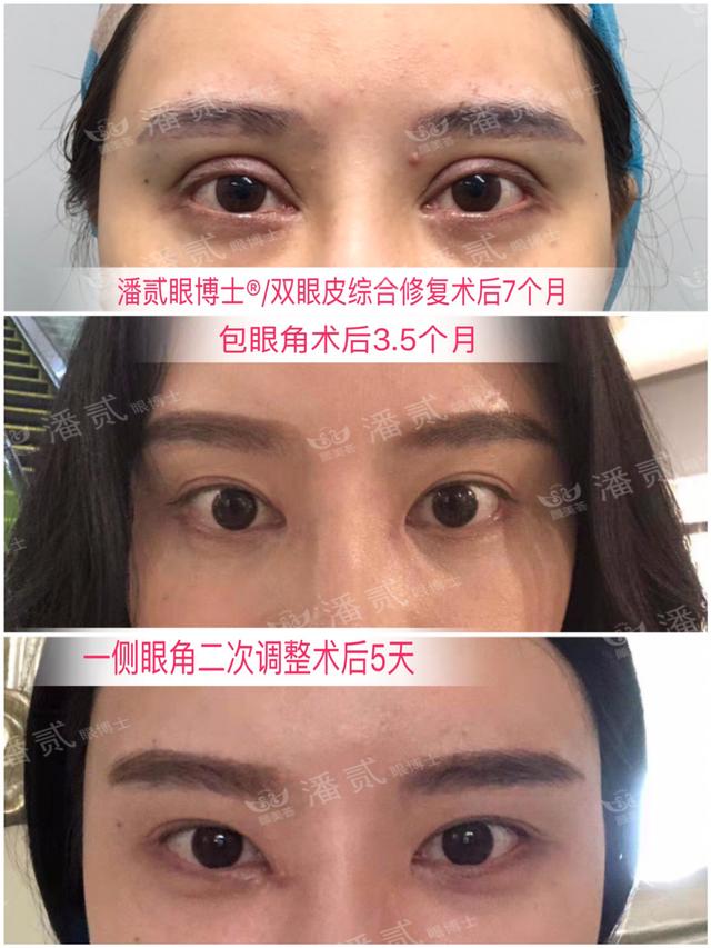 開了眼角後悔不已的案例 內眼角過大 露紅 括號 疤痕重 顯假 Kks資訊網