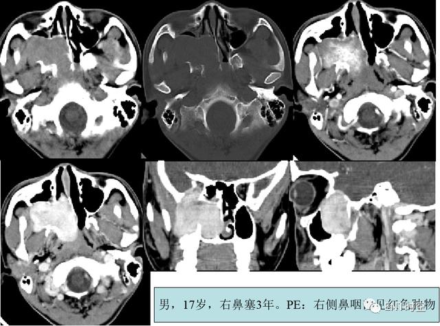 鼻咽鳞状上皮增生伴不全角化