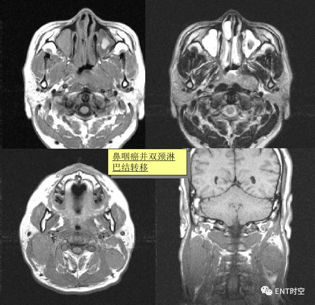 鼻咽鳞状上皮增生伴不全角化