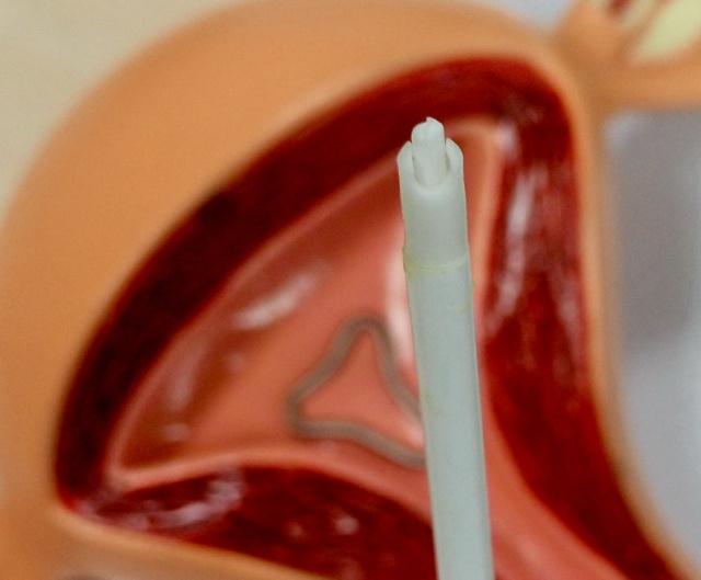 避孕环是什么原理（避孕环、节育环、宫内节育器是个啥）