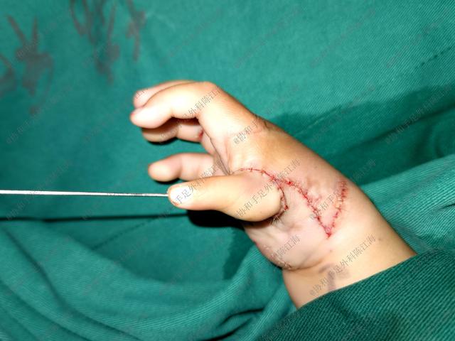 怎么判断宝宝的手是III型还是IV型的拇指发育不良？