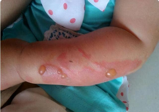 2岁女孩被开水烫伤，妈妈五步法救了孩子，医生也说做得好