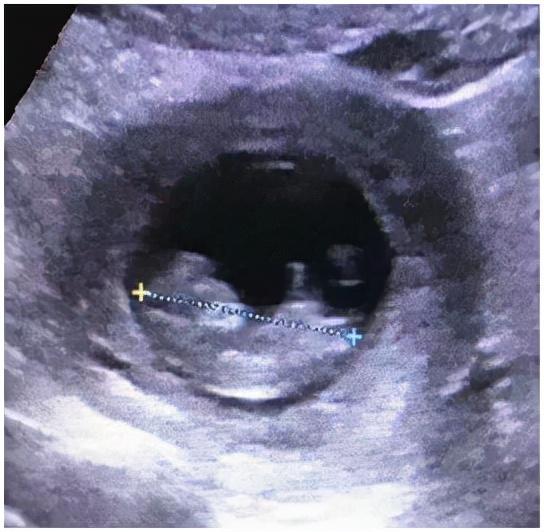 双胞胎隔“宫”相望，医生“攘外安内”