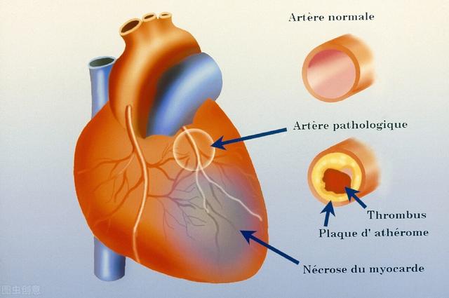 不想得冠心病、心绞痛，不想长期吃药、心脏放支架：做好这三条