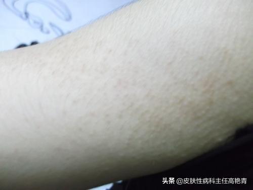毛周角化脸红怎么治