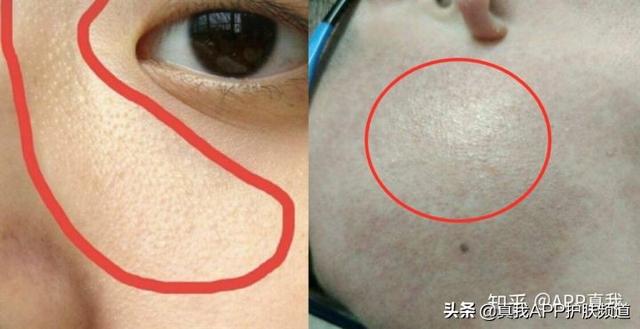 面部毛周角化怎么引起的