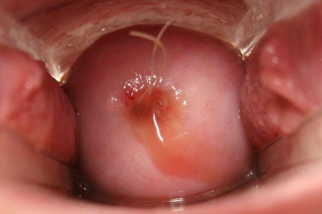 避孕环是什么原理（避孕环、节育环、宫内节育器是个啥）