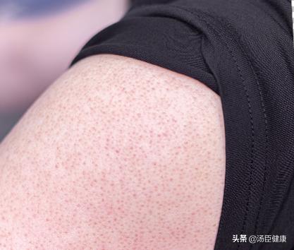 红色红点摸起来有点像鸡皮疙瘩