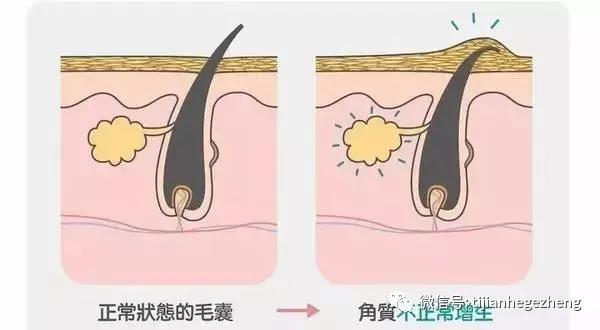 招飞体检常见皮肤异常：毛周角化症