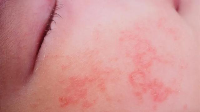 孕妇用了含有苯甲醇的身体乳