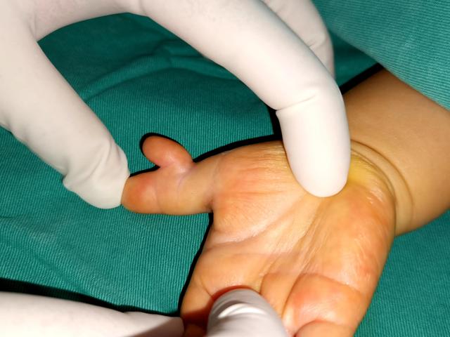 多指宝宝多大做手术合适？可以一出生就矫正吗？