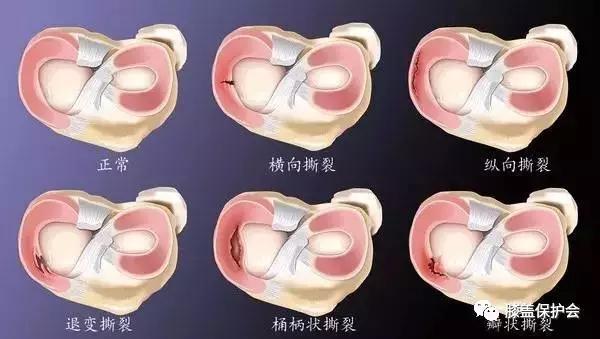 半月板是什么部位