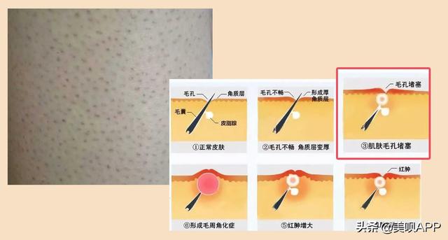 有毛周角化症怎么治