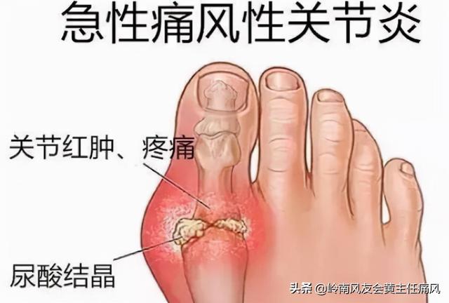 痛风发作时，秋水仙碱该不该吃？这几点要注意