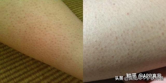 毛周角化症光学美容