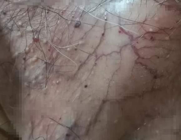 手皮肤角化质