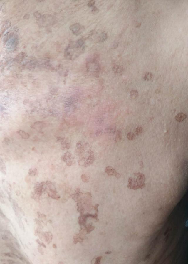 汗孔角化症外用什么药