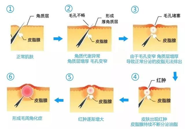 毛囊炎鱼鸡皮肤
