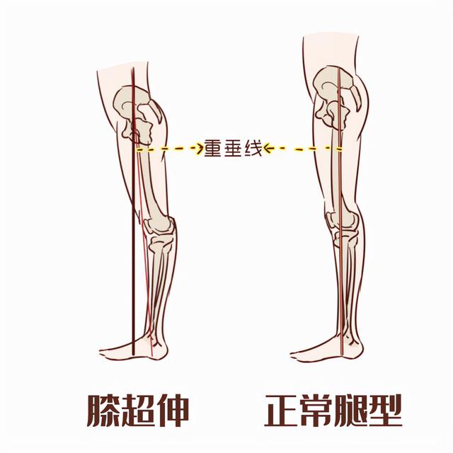腰后出现大凹陷 你的腰痛可能和 它 有关 今日热点