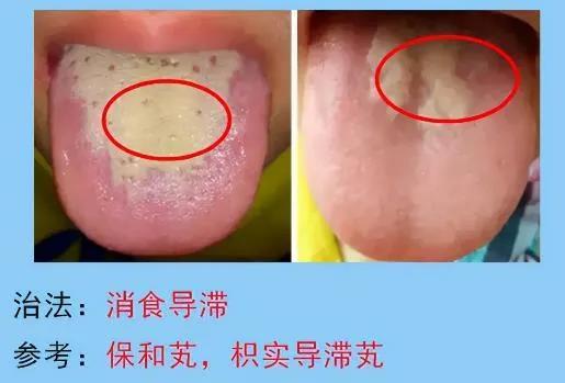 脾胃病的常见舌苔分析，脾胃不好的人要多多了解，你是图几？