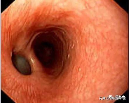 食道癌部分角化