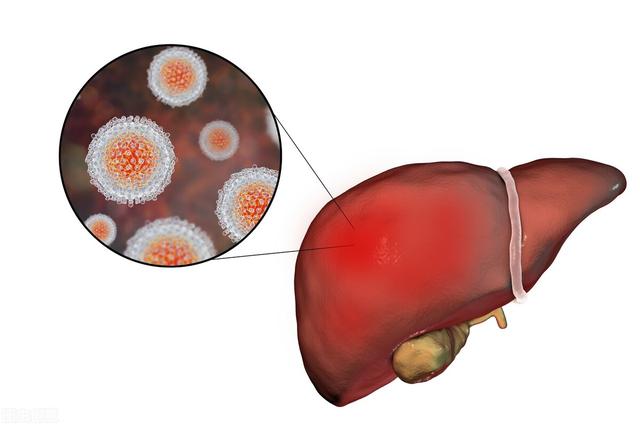 肝癌患者饮食该注意什么？提醒，这种常见食物要少吃