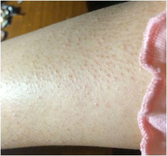 毛周角化症的多发季节