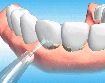 牙齿松动，这两种情况可以保住！牙医给出保牙秘籍