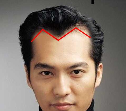 美人尖发际线是指我们额头中间的头发往下再长一点,形成三角尖的形状