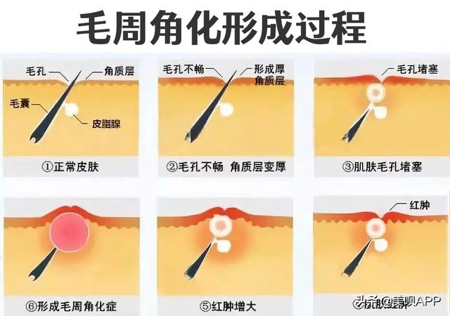 角质鸡皮肤做手术