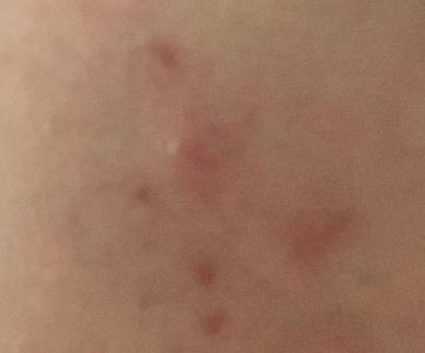 脸上长痘毛囊角化