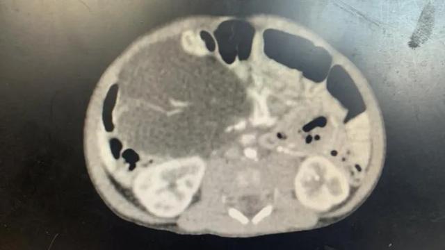 B超发现在左边，CT看着却在右侧！出生10天，宝宝腹部惊现“会运动”的拳头大肿瘤