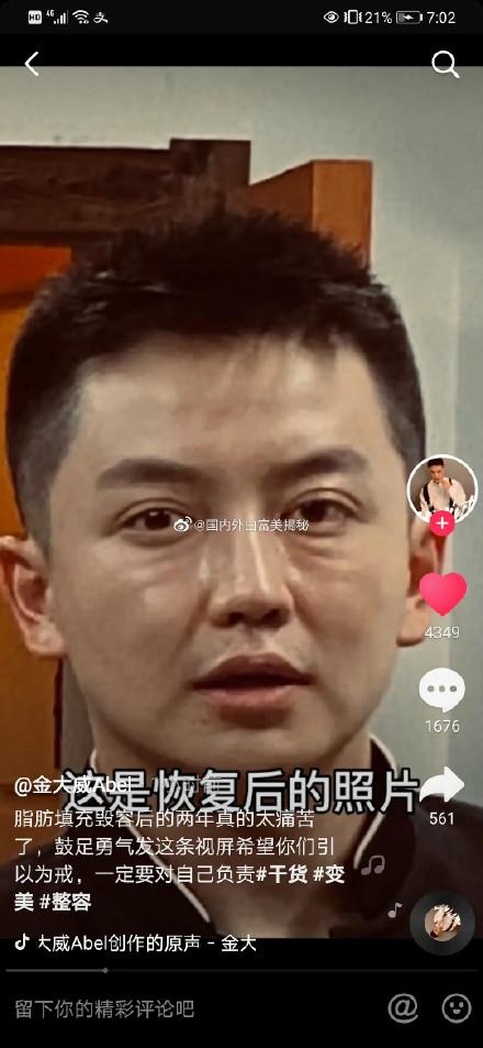 知名網紅金大威因整形失敗變成醜八怪 老歲痛哭 我好後悔 Kks資訊網
