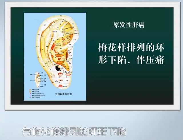 醫生提醒：癌變前，耳朵舌頭會“求救”！厚白苔肺癌，肝癭線肝癌