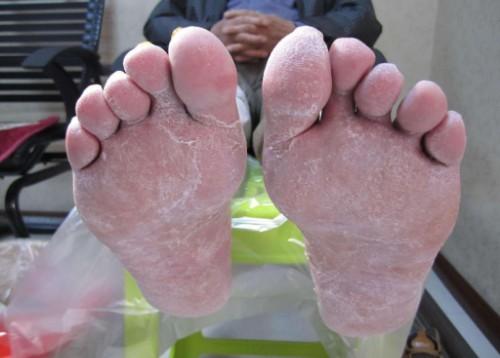 医生提示:糖尿病患者在出现糖尿病足时,早期一般有这3大症状