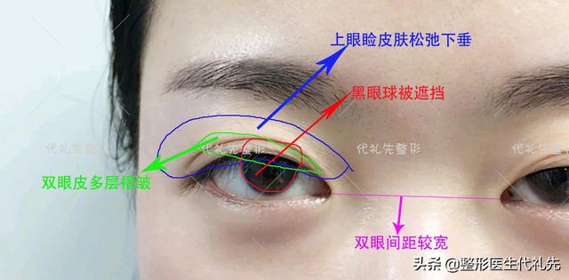 双眼皮胶