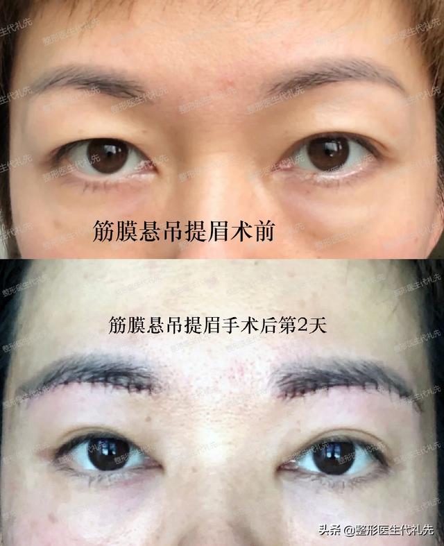 提眉手术大家问得最多的问题 细节公开 整形医生多年经验总结 全网搜